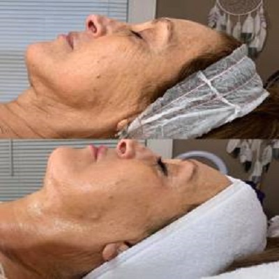 CryoSkin Cryo facial service at dunamis wellness